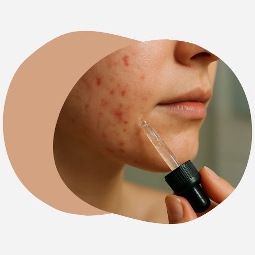 Traitement de l'acné : pourquoi le CBD peut compléter votre routine