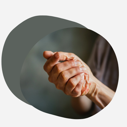 Gel al CBD: alleviare il dolore dell'osteoartrosi alle mani