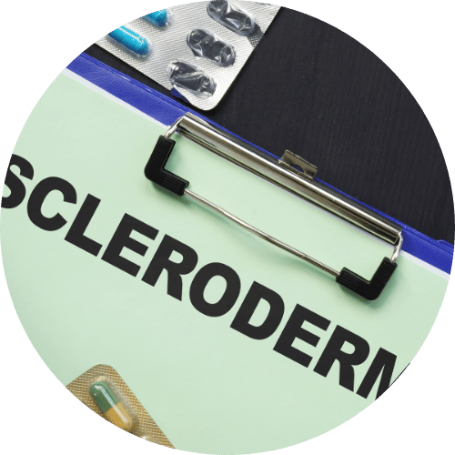 What is Scleroderma the role of Cannabidiol